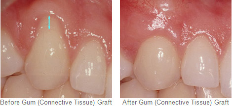 Before and After Gum Graft