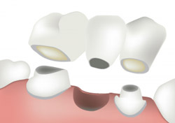 Dental Bridge