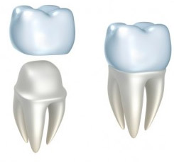 Porcelain Crowns