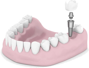 Dental Implants