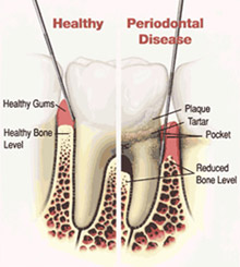 Healthy Gums versus Periodontal Disease