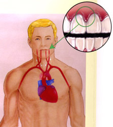 Periodontitis