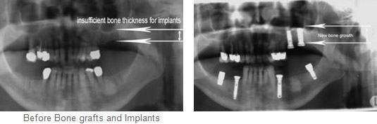 Before and After Bone Graft and Implants