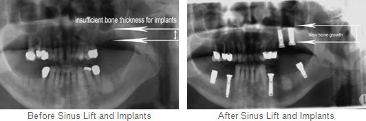 Before and After Sinus Lift