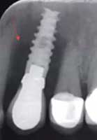 Peri-implant Boneloss