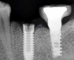 Fractured Implant