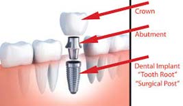 X-ray of implant