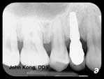 X-ray of implant